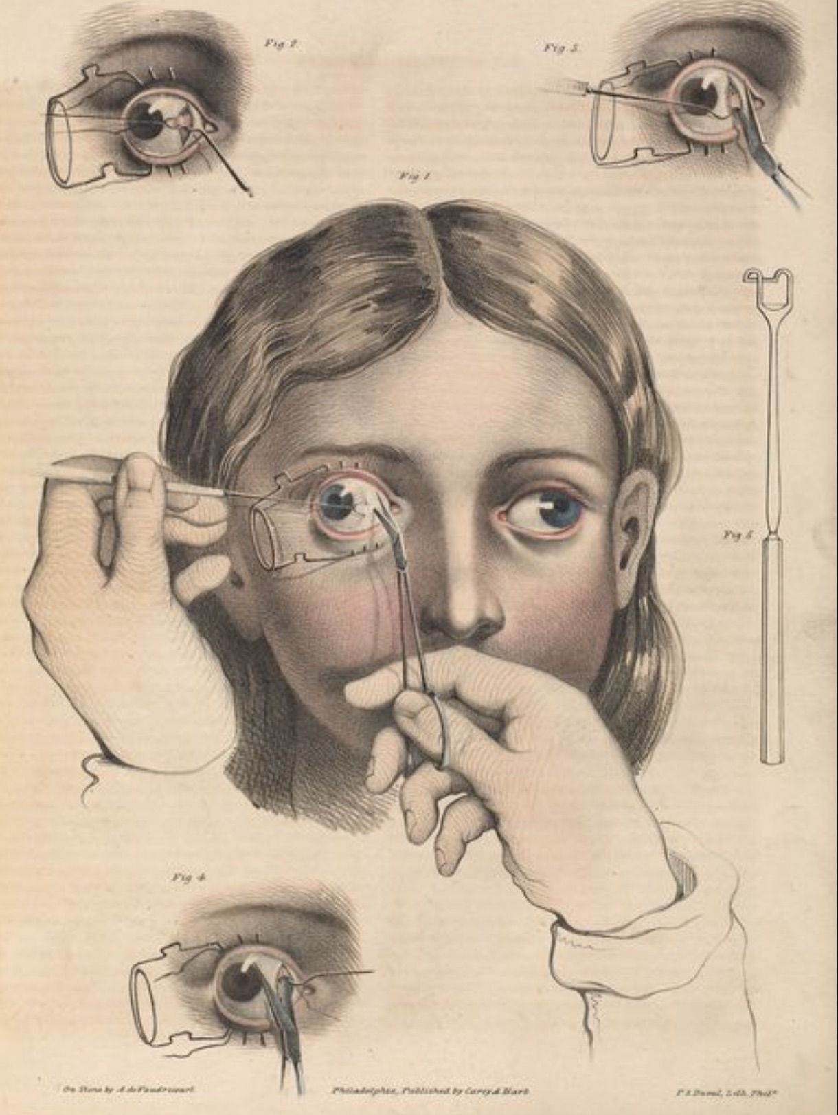 victorian era surgery - Prophes Pblished by Carey Hart Pdp"